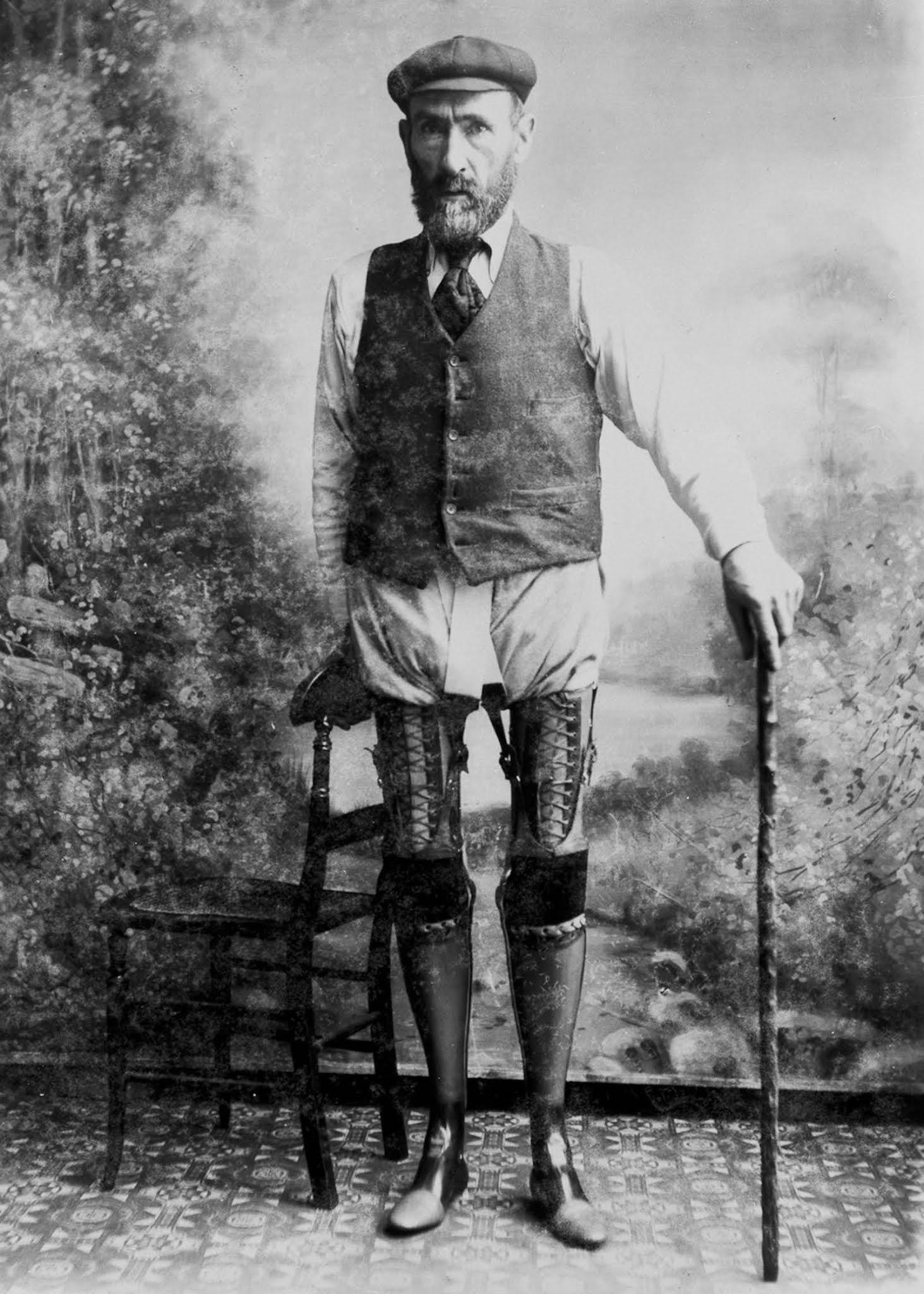 The extraordinary early prostheses made by James Gillingham  1900 - 64