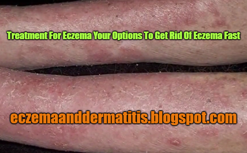 Treatment For Eczema Your Options To Get Rid Of Eczema Fast Eczema