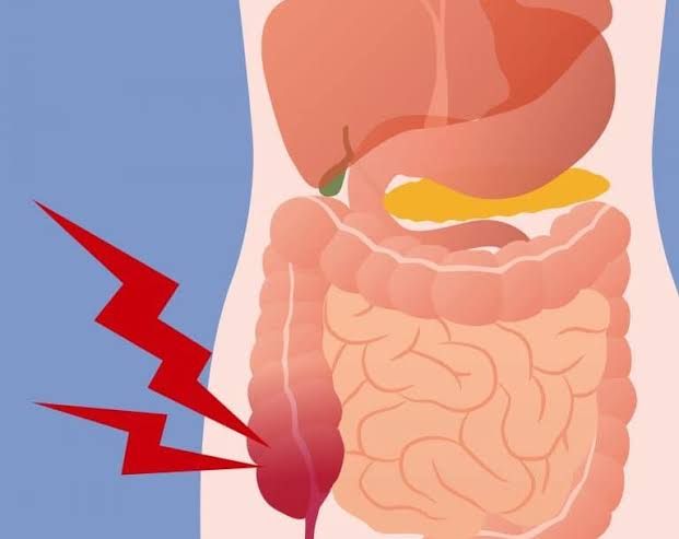 آلام الزائدة الدودية آلام الزائدة الدودية