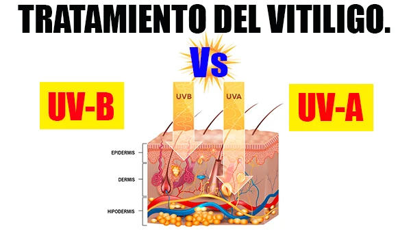 Tratamiento del Vitiligo con radiación UV-B Frente a Psoralen tópica más UV-A