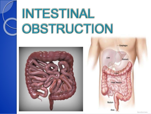 Obstruction Intestinal Mapa Mental obstruction-intestinal-mapa-mental