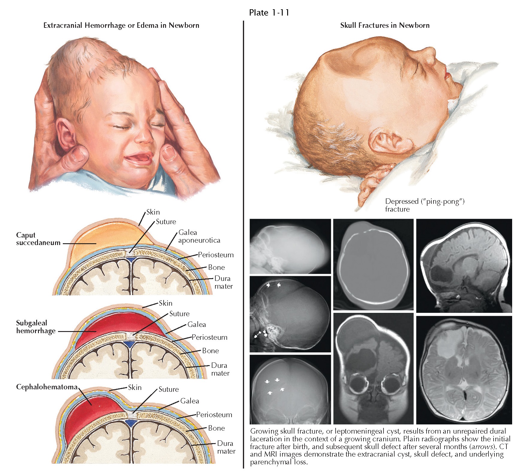 Extracranial Hemorrhage And Skull Fractures In The Newborn Pediagenosis