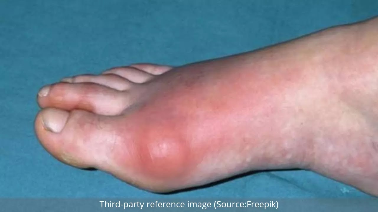 Gout : Symptoms, Causes and Natural Remedies | HealthInsta Gout : Symptoms, Causes and Natural Remedies | HealthInsta