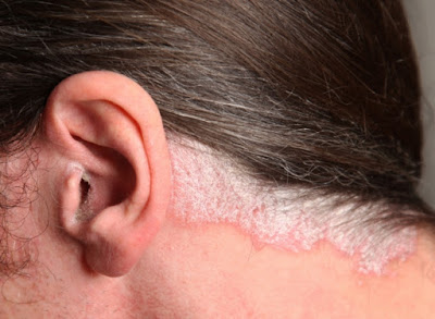 Choroby skóry głowy z nadmiernym złuszczaniem naskórka