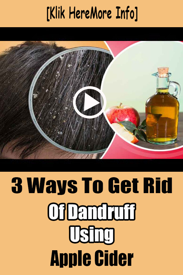 3 Ways To Get Rid Of Dandruff Using Apple Cider - eflstend
