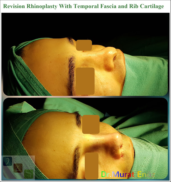 Revision Rhinoplasty With Temporal Fascia and Rib Cartilage Istanbul Turkey