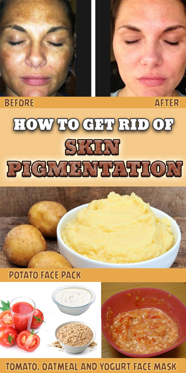 How to Get Rid of Skin Pigmentation HEALTH LIFESTYLE