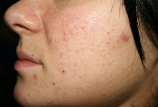 Pimples and Spots 