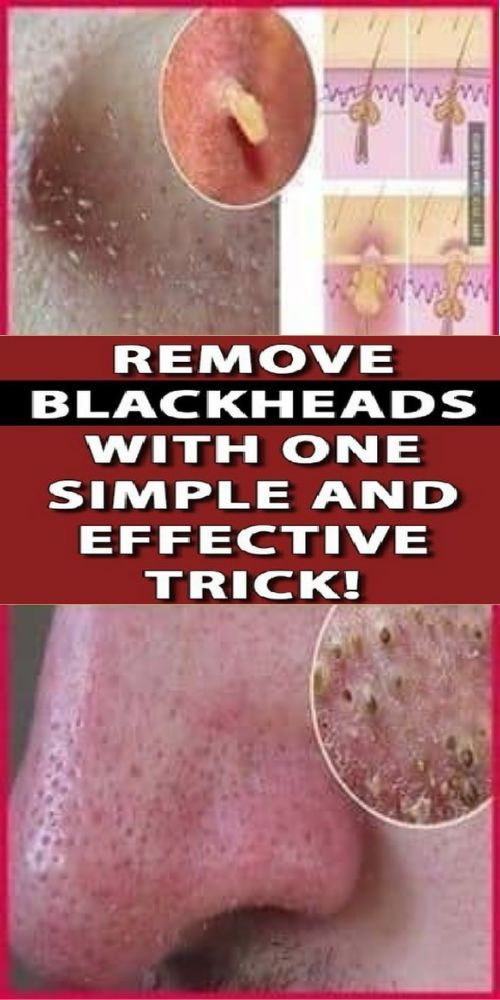 Remove Blackheads With One Simple And Effective Trick Healhty And Tips 