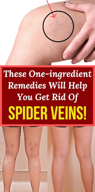 These One-ingredient Remedies Will Help You Get Rid Of Spider Veins!