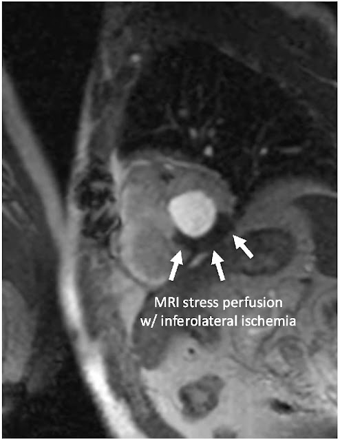 Cardiac magnetic resonance stress perfusion imaging, demonstrating inferolateral ischemia.