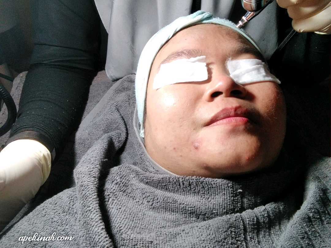 Buat Rawatan OxyPeel C Untuk Merawat Parut Di Dr Medispa & Wellness Buat Rawatan OxyPeel C Untuk Merawat Parut Di Dr Medispa & Wellness