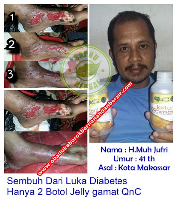Cara Mengobati Bentol Bernanah Di Tangan Dan Kaki Secara Alami Terbukti Ampuh - Testimoni QnC Jelly Gamat Cara Mengobati Bentol Bernanah Di Tangan Dan Kaki Secara Alami Terbukti Ampuh - Testimoni QnC Jelly Gamat
