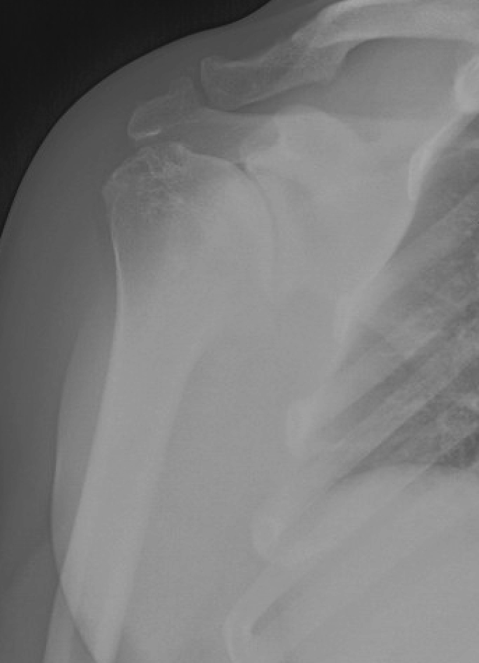 UW Shoulder and Elbow Academy Ream and run for shoulder arthritis in a