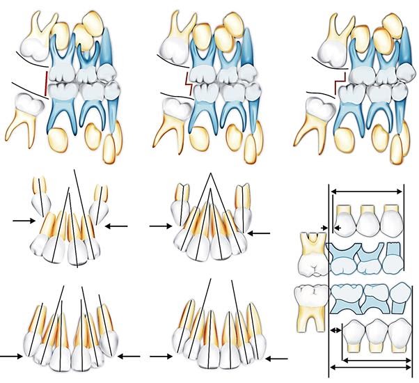 Normal occlusion l orthodontics MCQ in dentistry WikiDentia