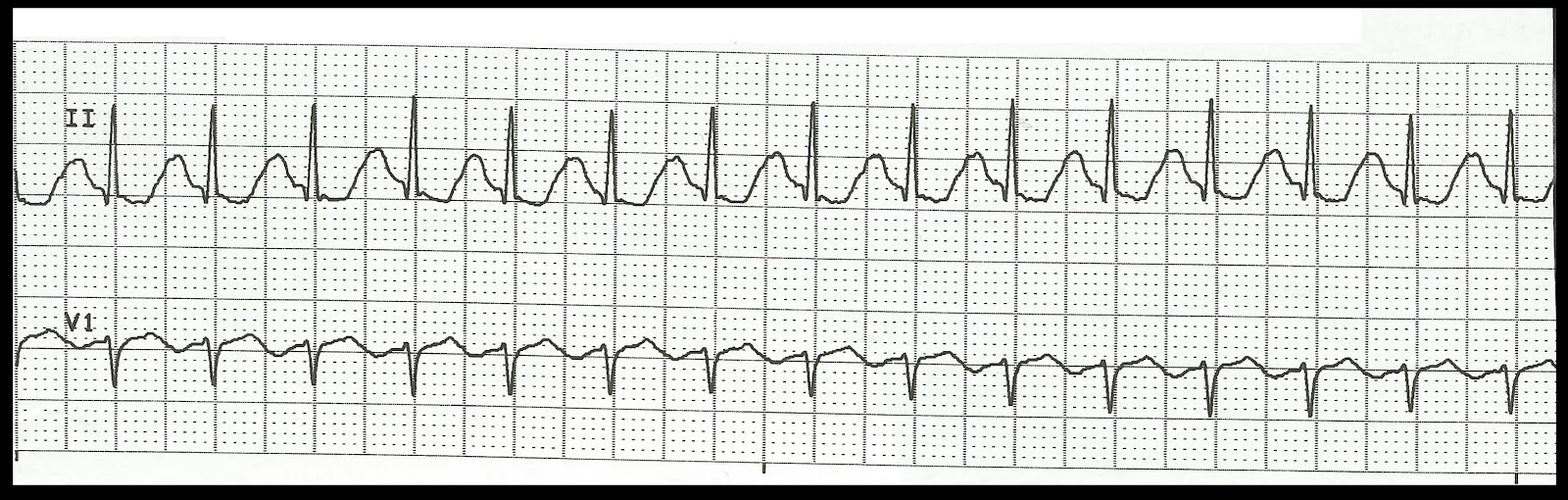 Float Nurse: Practice EKG Rhythm Strips 132