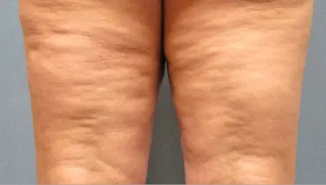 anti celluite, At War With Celluite anti celluite, At War With Celluite