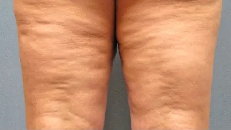 anti celluite, At War With Celluite anti celluite, At War With Celluite
