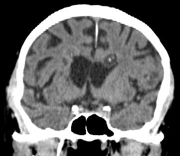 Neurocysticercosis