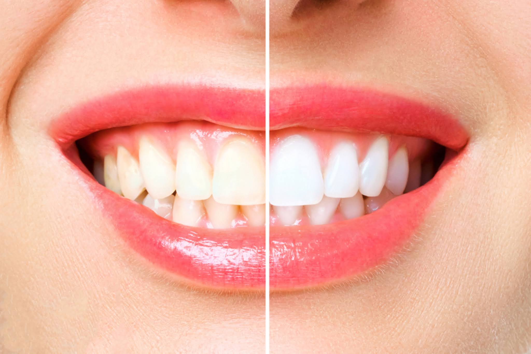 Five Tips to Maintain Your Teeth After Teeth Whitening