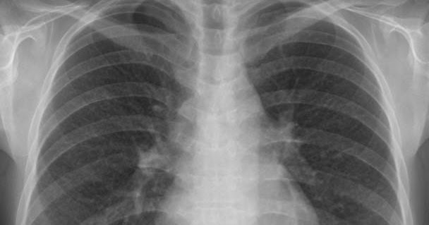 rit-radiology-miliary-tuberculosis