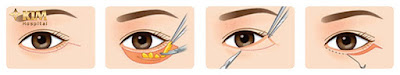 Cách chữa bọng mỡ mắt dưới  2