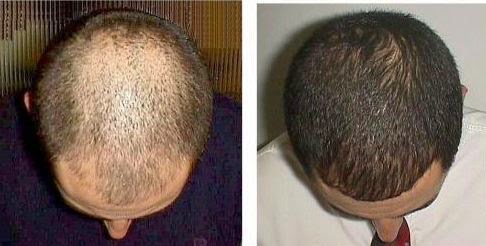 Minoxidil Before And After Beard Result : The Struggle to Grow a Beard
