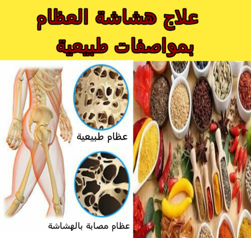 العلاج الطبيعي لهشاشة العظام