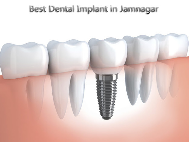 dental implant at jamnagar