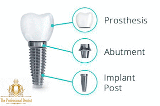 dental implants : definition, indications and contraindications dental implants,dental implant,dental,cost of dental implants,implants,dental implant review,dream dental implant center,price of dental implants,dental implant lecture,dental implant procedure,implant,all on four dental implants,dental implant cost,dental implant prices,dental implant training,dental implant education,dental implant treatment