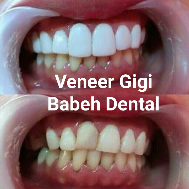 BABEH DENTAL HARGA veneer gigi 2023 PALING MURAH dI lampung, harga