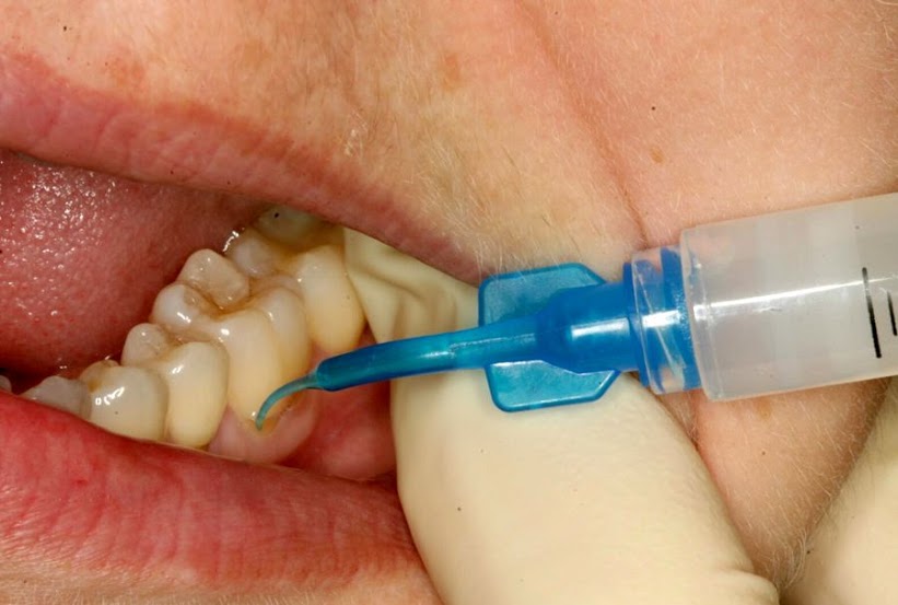 WEBINAR OZONE THERAPY´S Promise to Save Lives, Not Just Teeth Dr