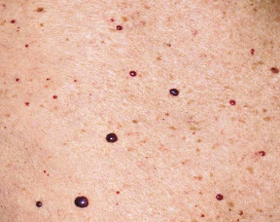 Cherry-angioma-4.jpeg