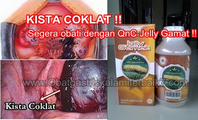 Cara Ampuh Menghancurkan Kista Coklat Tanpa Operasi Cara Ampuh Menghancurkan Kista Coklat Tanpa Operasi