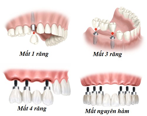 LƯU Ý CỰC KỲ QUAN TRỌNG BẠN CẦN NẮM RÕ KHI CẤY GHÉP IMPLANT -5