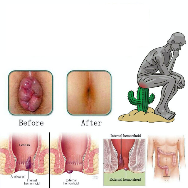 Bệnh trĩ là gì, tìm hiểu về bệnh trĩ nội, trĩ ngoại, trĩ hỗn hợp