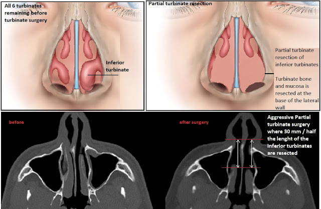 Partial turbinate surgery Anders Arbrandt är en kirurg på Sahlgrenska som genomför aggressiv och konventionell Conchaplastik som orsakat sekundär atrofisk rinit och Emty nose syndrome.