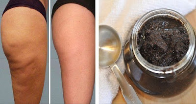 Dites adieu à la peau d'orange: Crème au café pour éliminer la cellulite