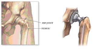 HIP REPLACEMENT SURGERY