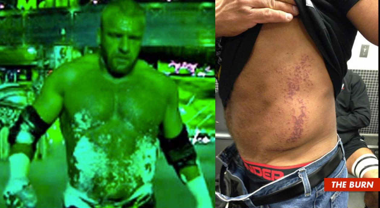 ProEntertainment Wrestling TRIPLE H I Suffered 2nd Degree Burns