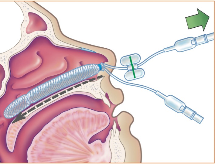 Endoscopic Sinus Surgery
