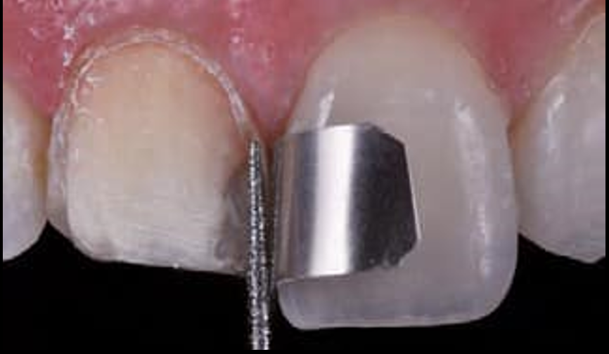 Ceramic veneers preparartion .. Part 2 " Conventional preparation