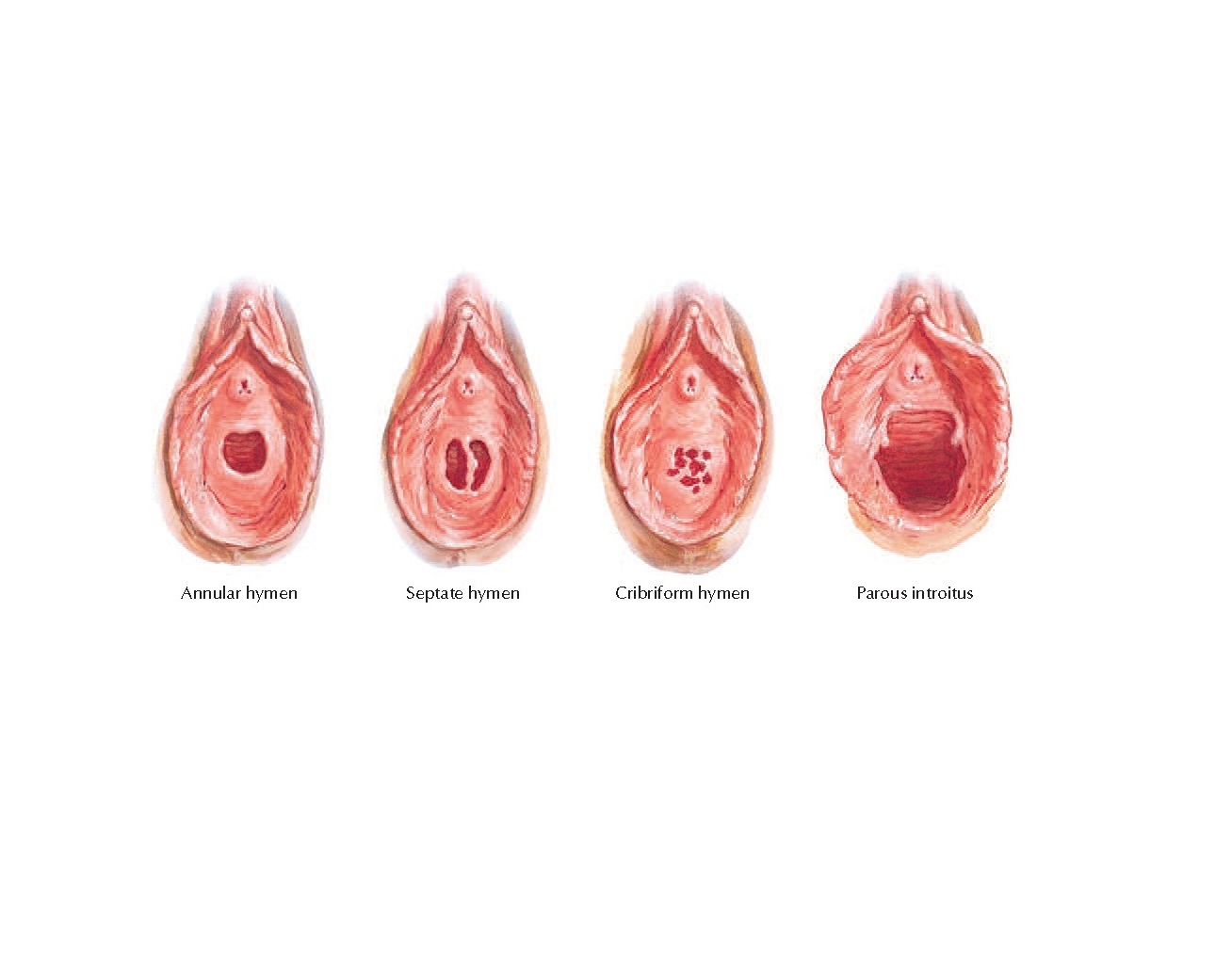 Variations in Hymen Anatomy - pediagenosis