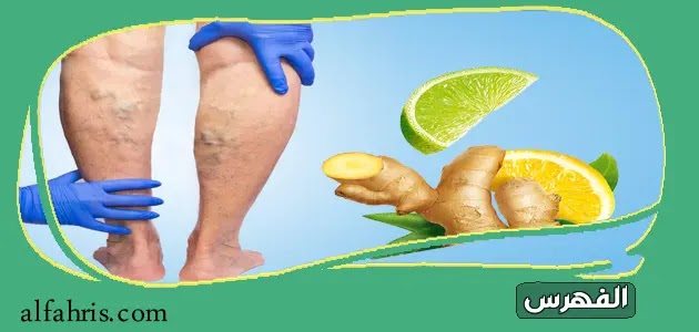 علاج دوالي الساقين في المنزل بالأعشاب والليمون