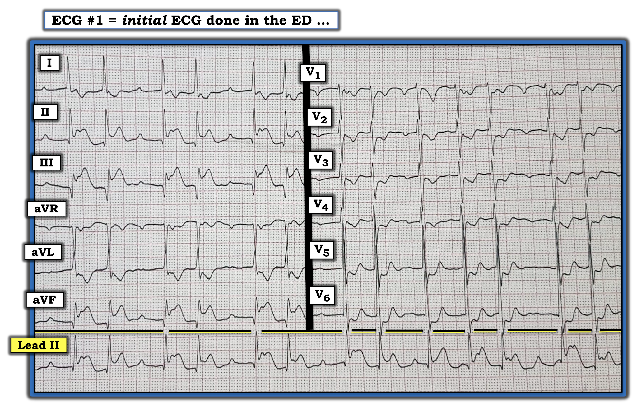 экг в 12 ти отведениях. экг норма в 12 отведениях. экг левограмма норма. экг в 12 ти отведениях. регистрация экг в трех стандартных отведениях.