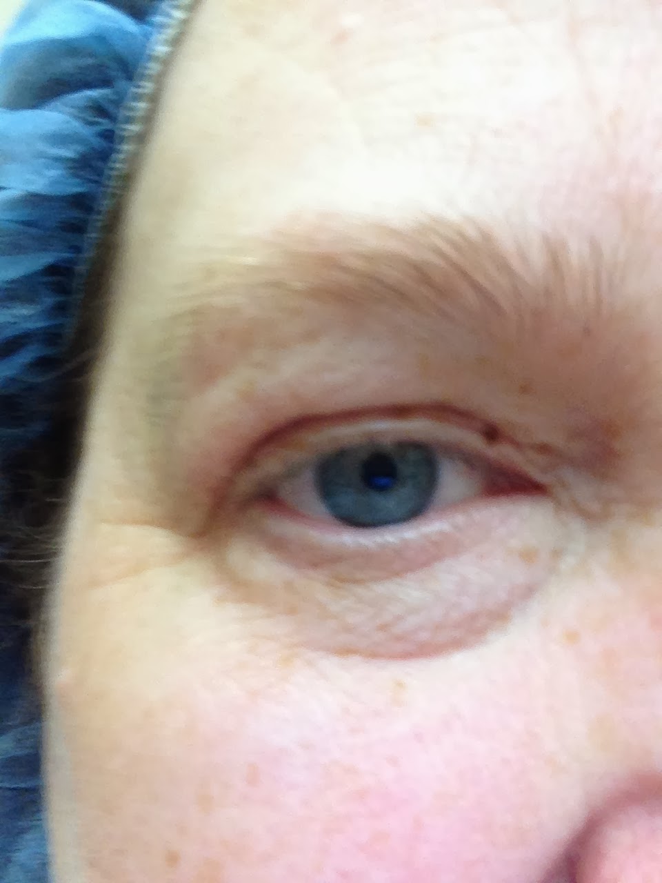 eye pupil swollen eye pupil swollen