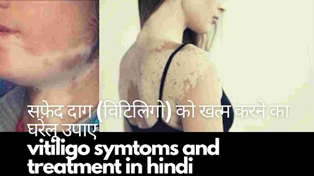  क्या सफ़ेद दाग (विटिलिगो) ठीक हो सकता है जाने घरेलू इलाज - home remedies of white spots in hindi