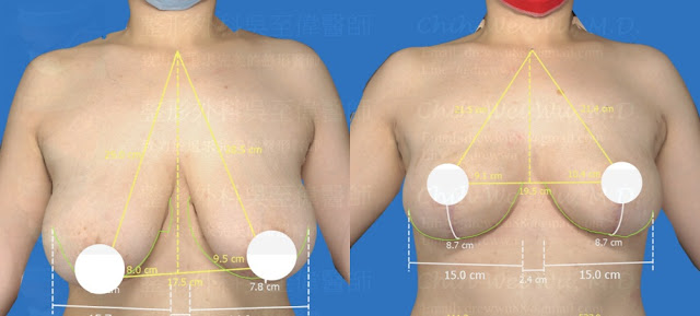 此案例術前為G罩杯與嚴重乳房下垂，經縮胸手術後結果對稱，胸部自然令人滿意