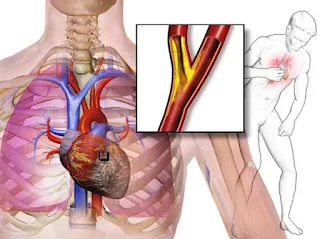 Angina pektoris