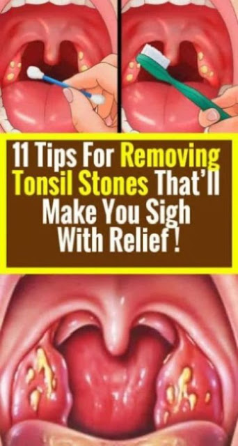 Tips On Removing Tonsil Stones With Relief ! - medicine health life